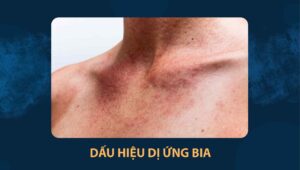 dấu hiệu dị ứng bia