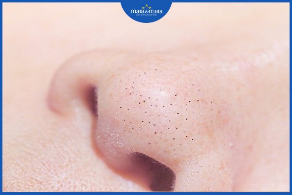 mụn đầu đen và mụn đầu trắng