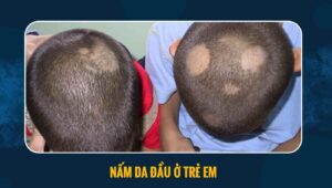 nấm da đầu ở trẻ em