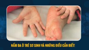 nấm da ở trẻ sơ sinh