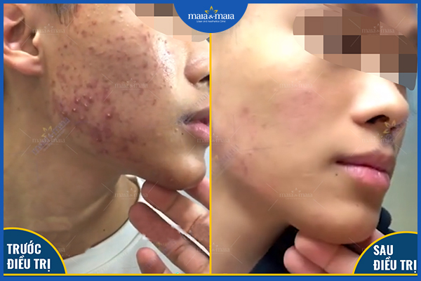 Sau khi điều trị mụn cần có chế độ chăm sóc da nghiêm ngặt