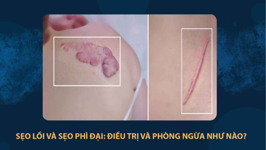 sẹo lồi và sẹo phì đại