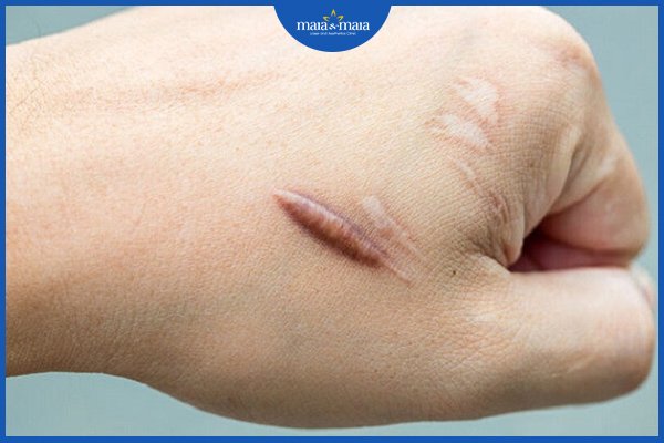 vết sẹo bị sưng