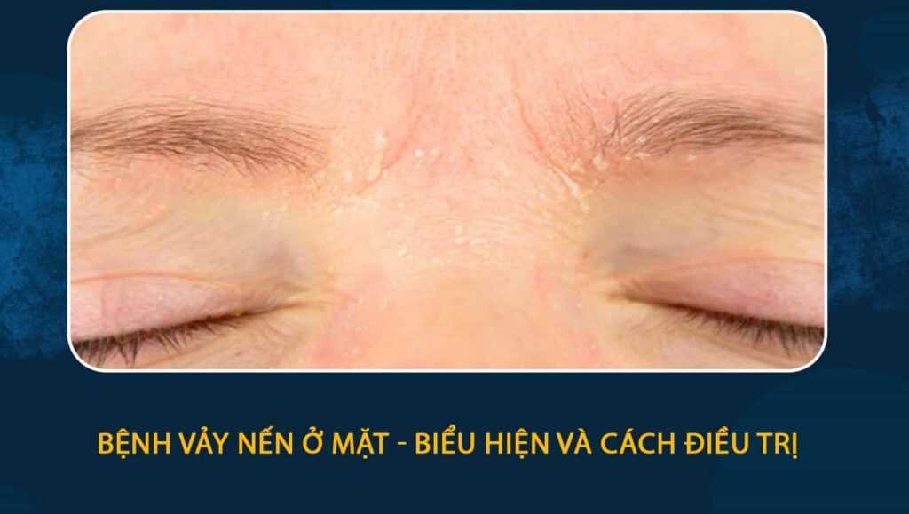 bệnh vẩy nến ở mặt