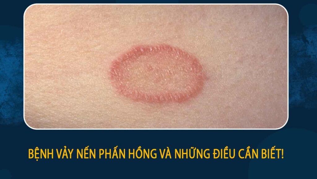 Bệnh vảy nến phấn hồng