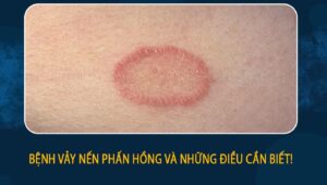 Bệnh vảy nến phấn hồng