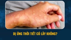 Dị ứng thời tiết có lây không?