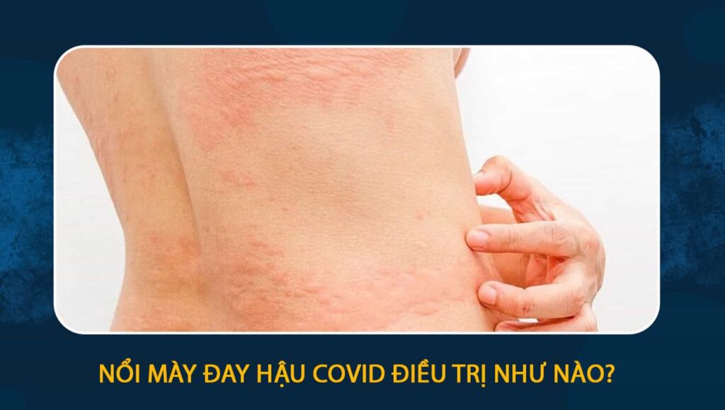 nổi mày đay hậu covid
