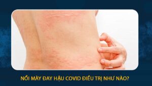 nổi mày đay hậu covid