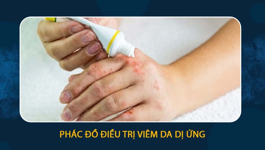 phác đồ điều trị viêm da dị ứng