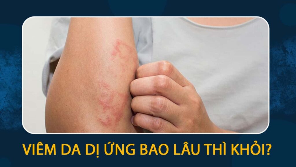 viêm da dị ứng bao lâu thì khỏi