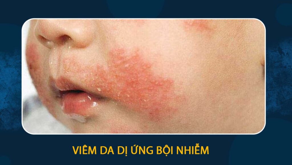 viêm da dị ứng bội nhiễm