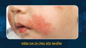 viêm da dị ứng bội nhiễm