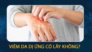 viêm da dị ứng có lây không