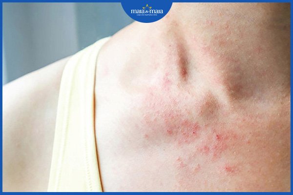 viêm da dị ứng mãn tính