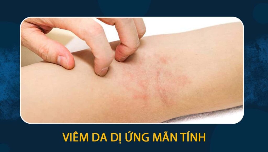 viêm da dị ứng mãn tính