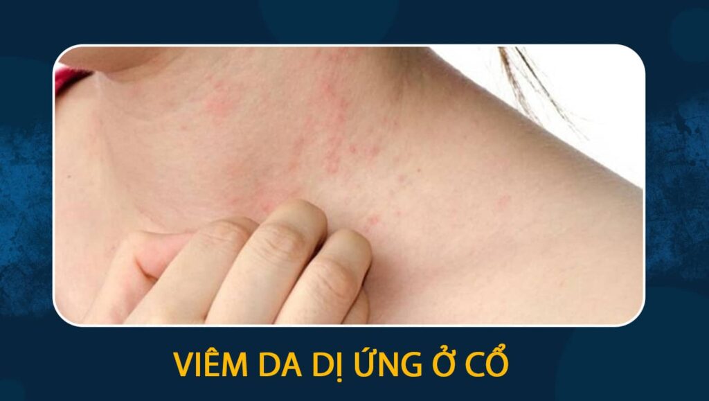 viêm da dị ứng ở cổ