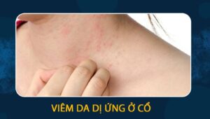 viêm da dị ứng ở cổ