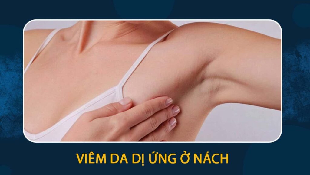 viêm da dị ứng ở nách