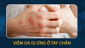 viêm da dị ứng ở tay chân