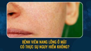 bệnh viêm nang lông ở mặt