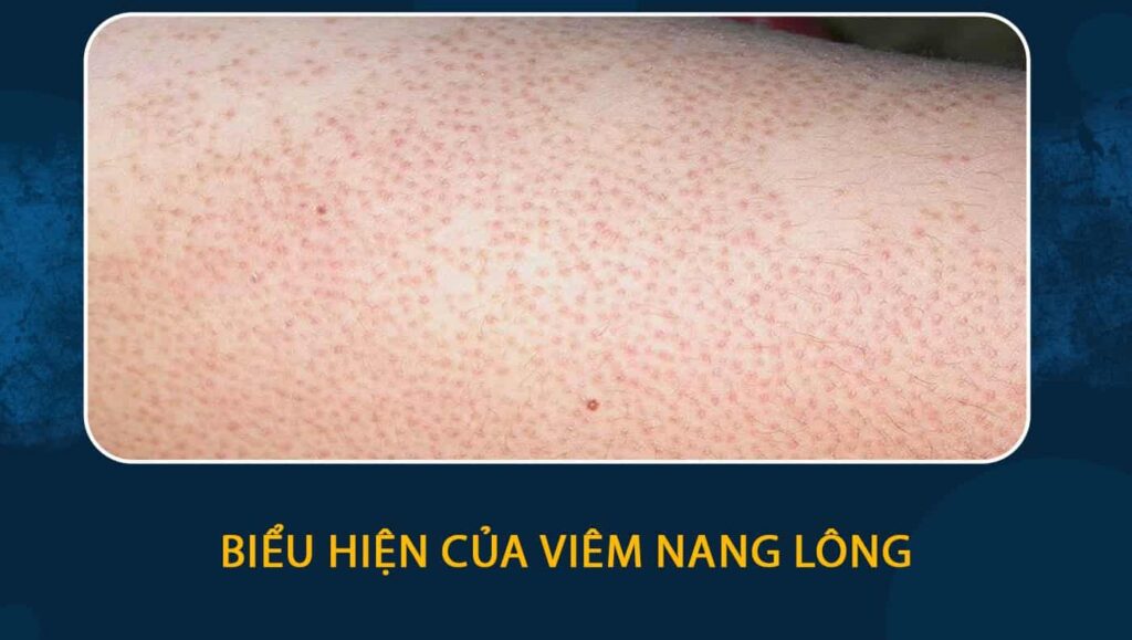 Biểu hiện của viêm nang lông