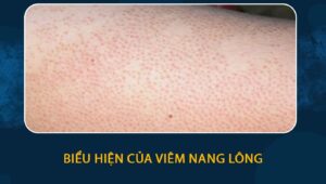 Biểu hiện của viêm nang lông