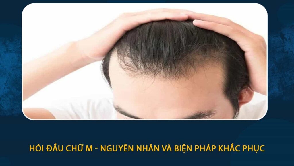 hói đầu chữ m