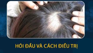 hói đầu và cách điều trị