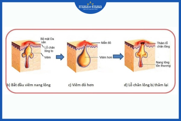 Nang lông bị tắc nghẽn