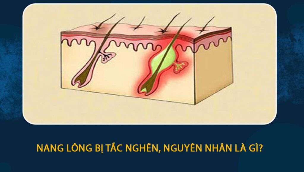 Nang lông bị tắc nghẽn