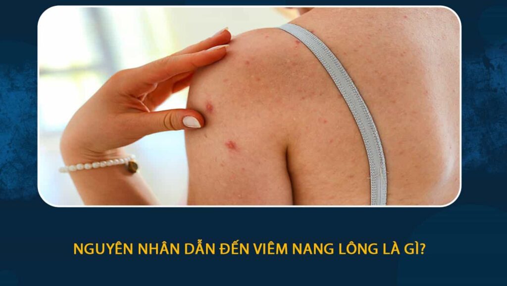Nguyên nhân dẫn đến viêm nang lông