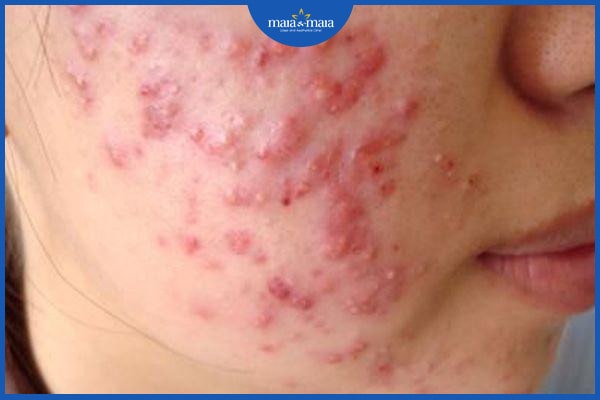 Phân biệt viêm nang lông và mụn trứng cá