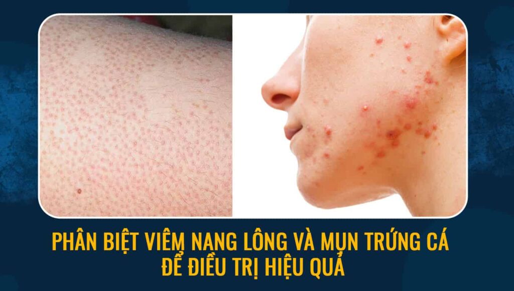 Phân biệt viêm nang lông và mụn trứng cá