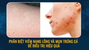 Phân biệt viêm nang lông và mụn trứng cá