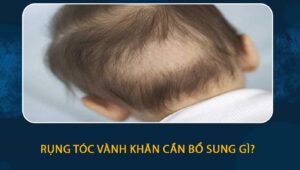 Rụng tóc vành khăn cần bổ sung gì