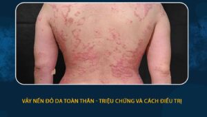 vảy nến đỏ da toàn thân