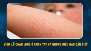 viêm lỗ chân lông ở chân tay