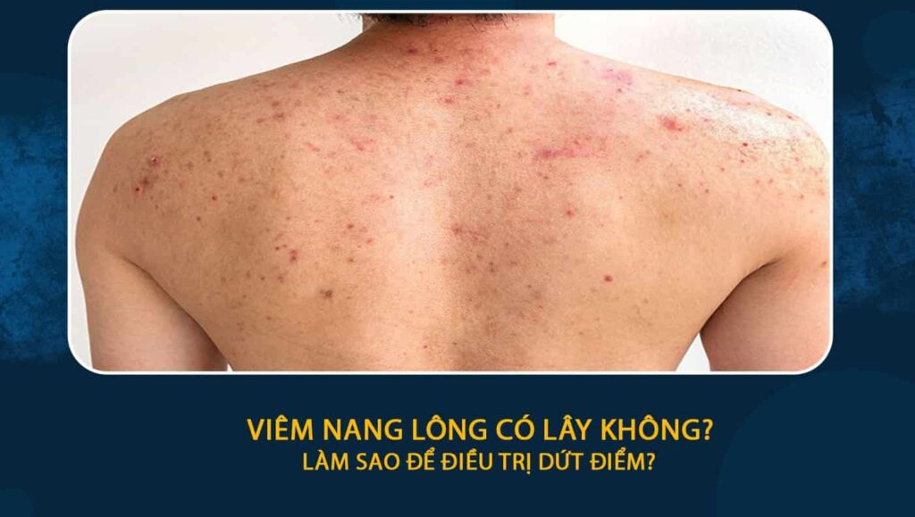 Viêm nang lông có lây không