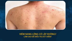 Viêm nang lông có lây không