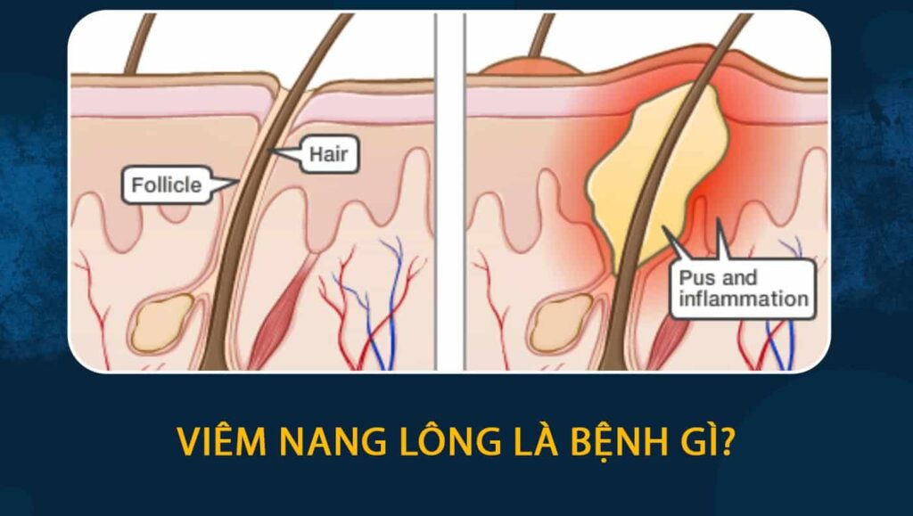 Viêm nang lông là bệnh gì
