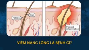 Viêm nang lông là bệnh gì