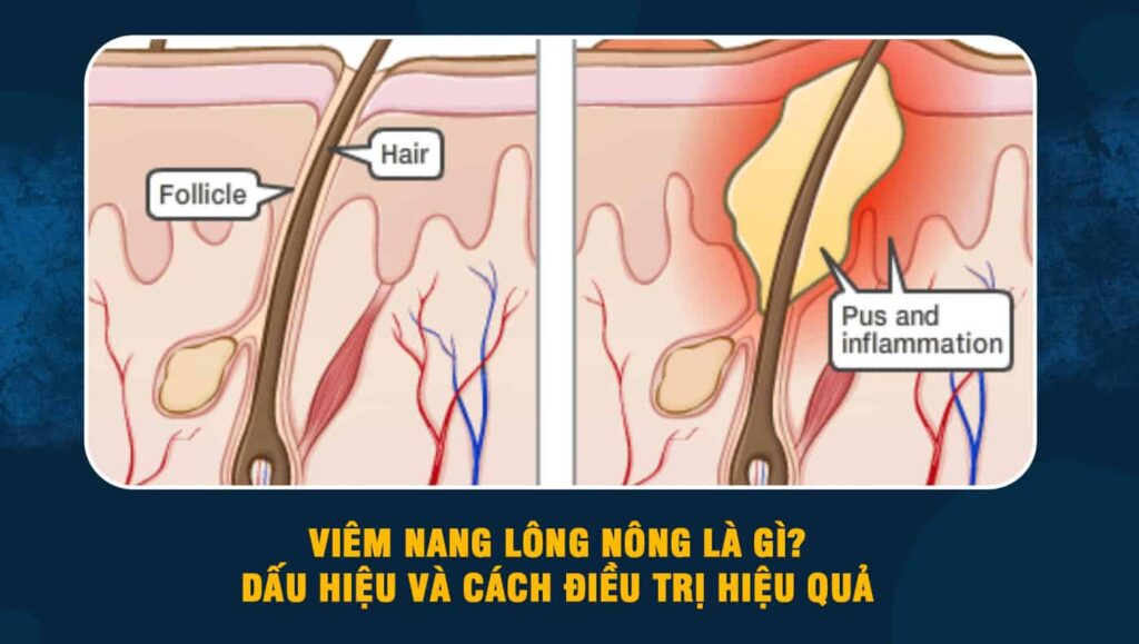 Viêm nang lông nông