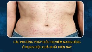 viêm nang lông ở bụng