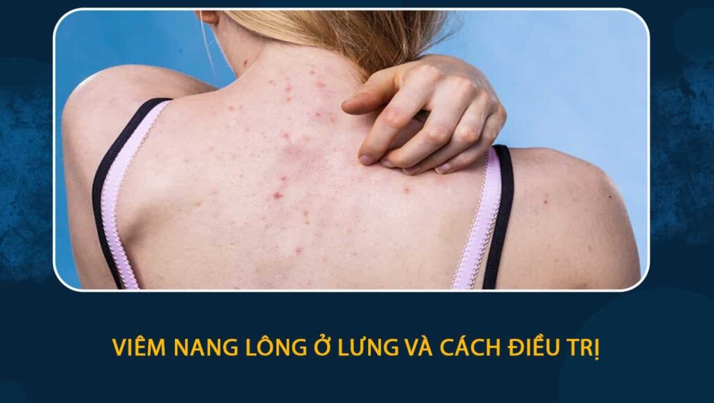 Viêm nang lông ở lưng và cách điều trị