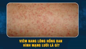 Viêm nang lông hồng ban hình mạng lưới