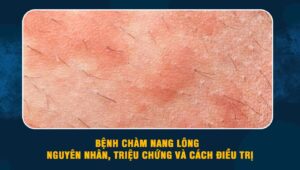 Bệnh chàm nang lông