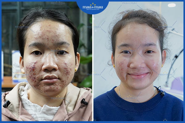 biểu hiện của mụn trứng cá