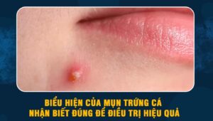 biểu hiện của mụn trứng cá
