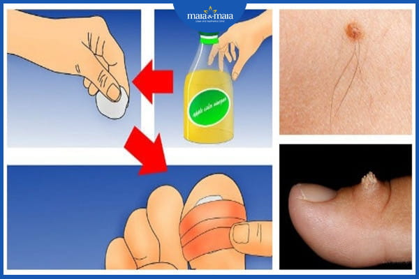 cách trị mụn cóc nhanh nhất tại nhà